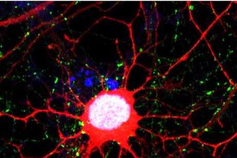 Una cellula di glioblastoma proveniente da una recidiva del tumore (fonte: Cancer Cell)