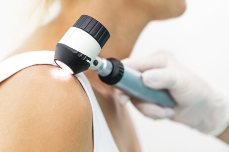 Melanoma, +30% di diagnosi nel 2024 ma cresce l'immunoterapia