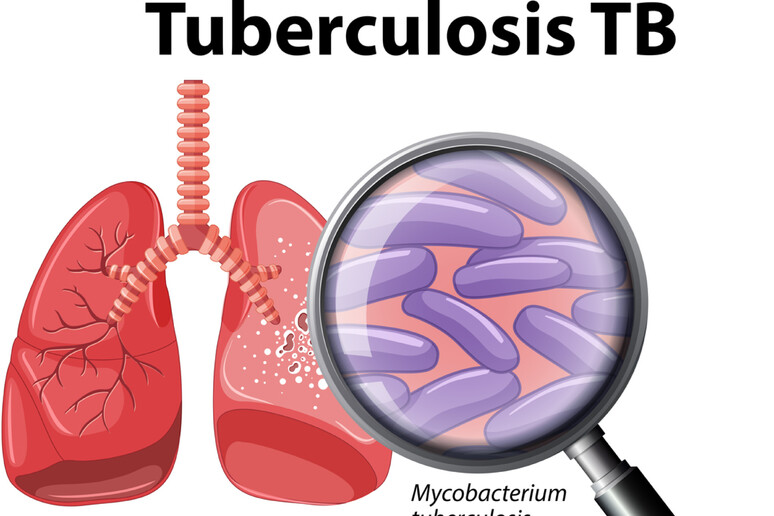 Tbc  'principale minaccia infettiva ',8,2 milioni di casi nel 2023 - RIPRODUZIONE RISERVATA